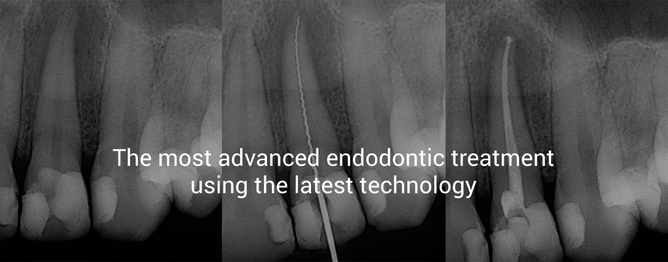 Root Canal Treatment