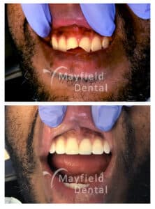 Dental Emergency before and after